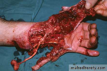 Wounds