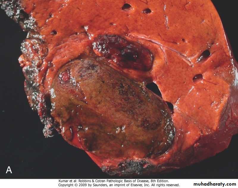 LIVER