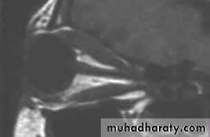 thyroid g