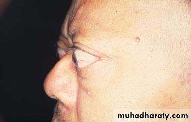 thyroid g