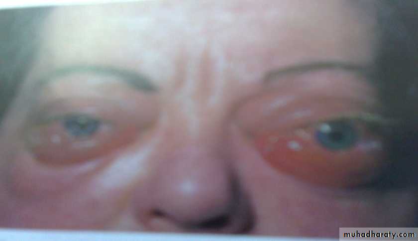 thyroid g