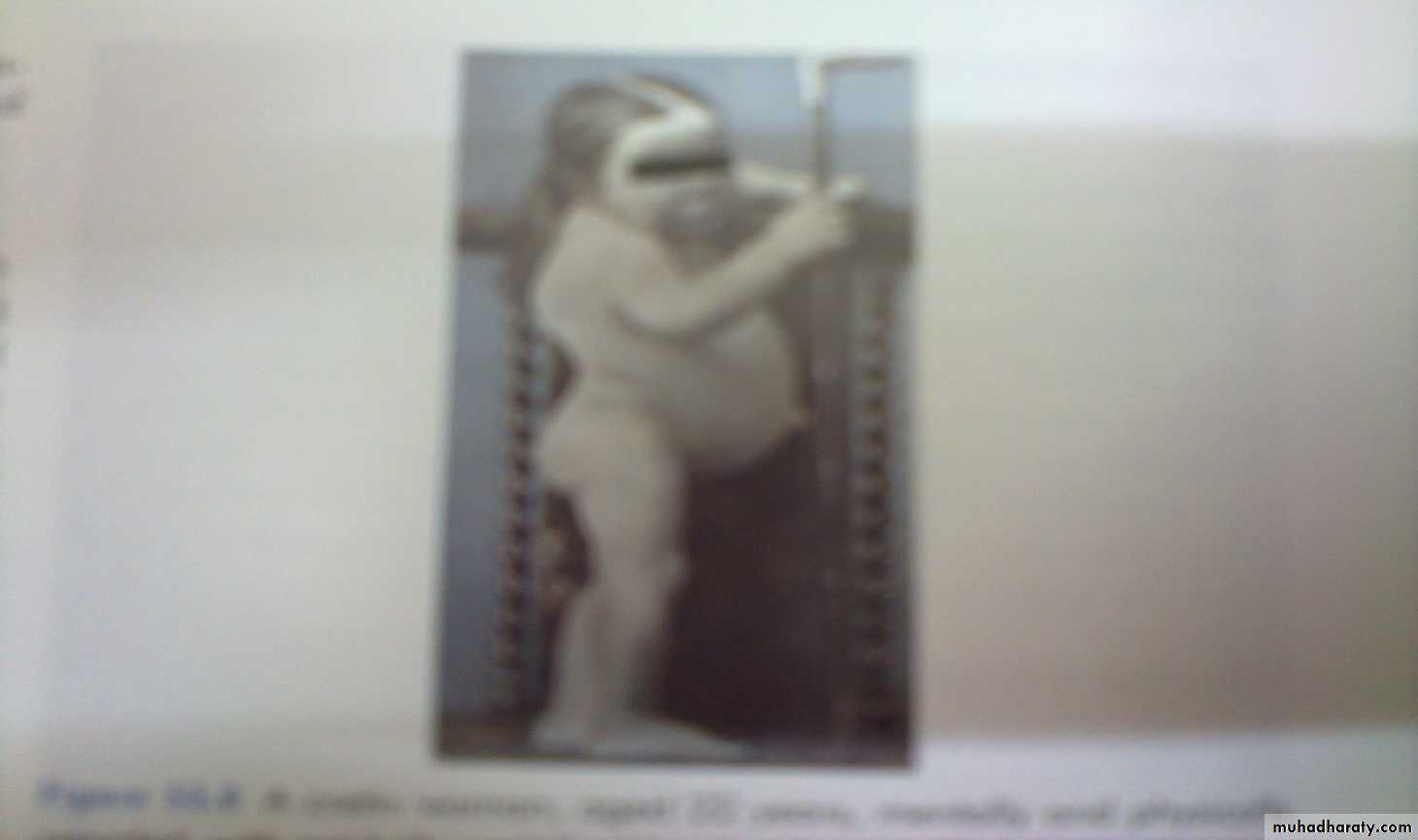 thyroid g