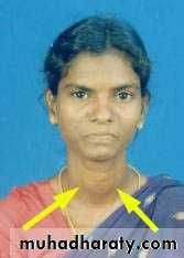 thyroid g