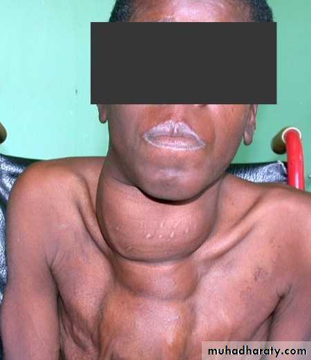 thyroid gland