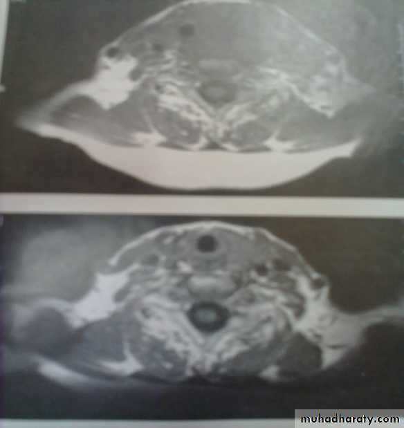 thyroid gland