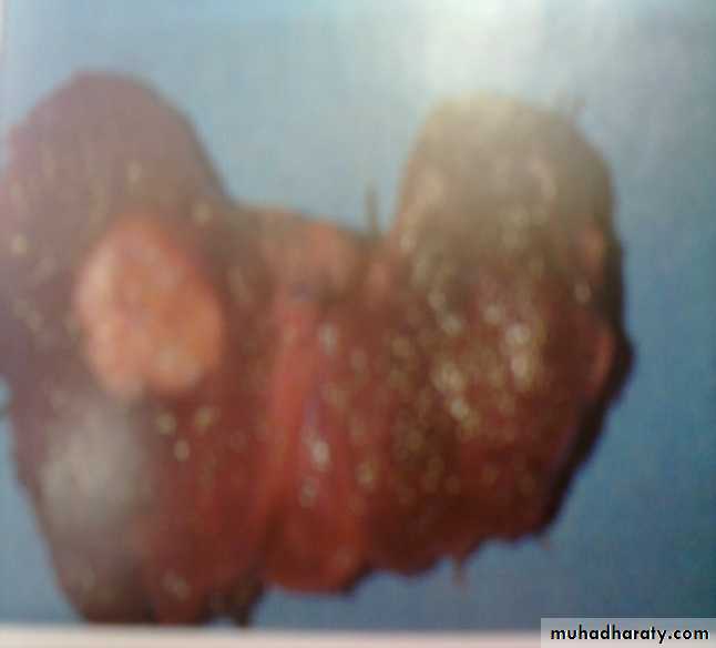 thyroid gland