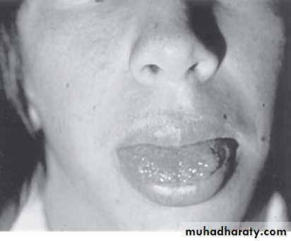 thyroid gland