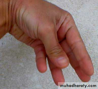 thyroid gland