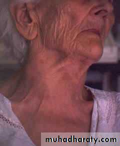 thyroid gland