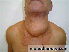 thyroid gland