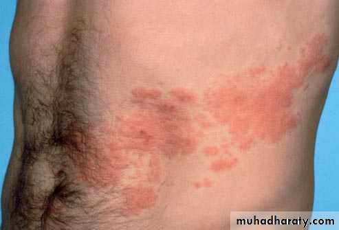 Infectious mononucleosis