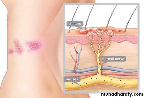 Infectious mononucleosis