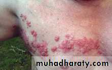 Infectious mononucleosis