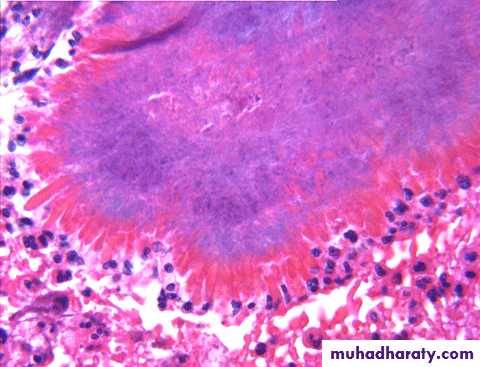 infectious diseases