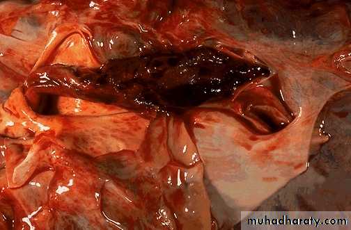 Hemodynamic Disorders