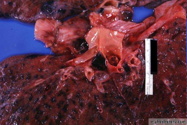 Hemodynamic Disorders