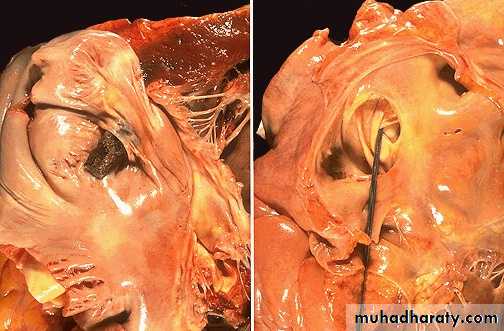 Hemodynamic Disorders