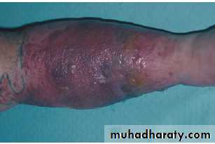inflammation