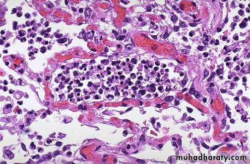 inflammation