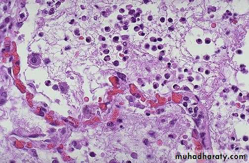 inflammation