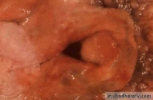 inflammation
