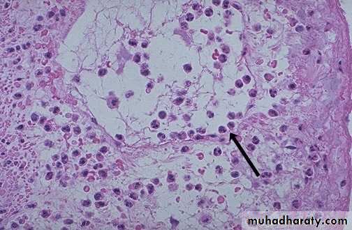 inflammation