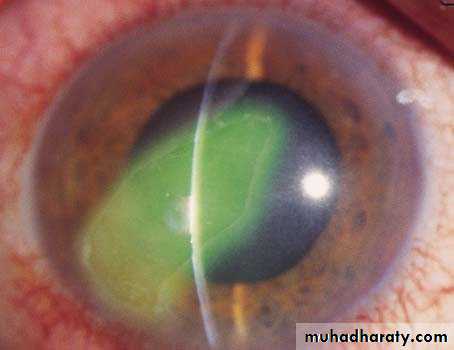 cornea
