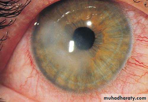 cornea