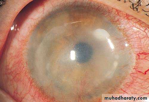 cornea