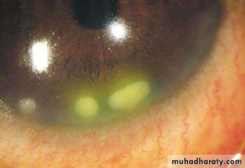 cornea