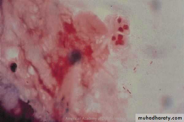 cornea