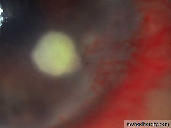 cornea