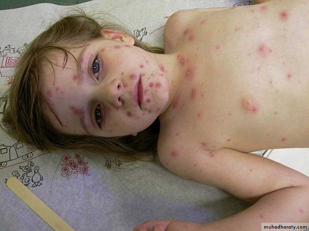 chicken pox small pox mumps