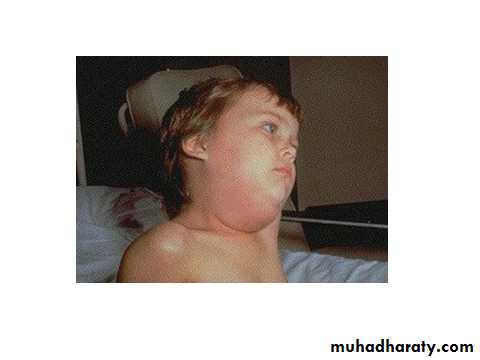 chicken pox small pox mumps
