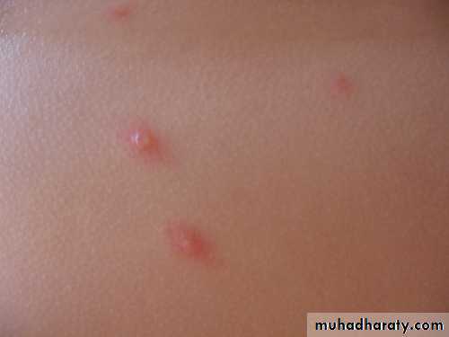 chicken pox small pox mumps