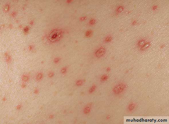 chicken pox small pox mumps