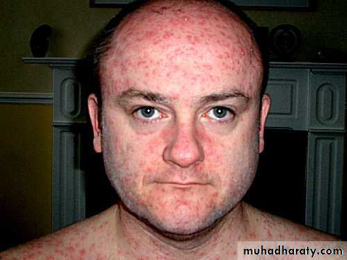 chicken pox small pox mumps