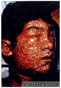 chicken pox small pox mumps