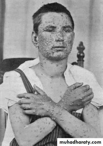 chicken pox small pox mumps
