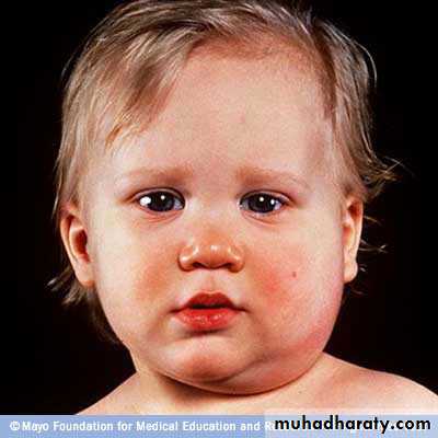 chicken pox small pox mumps
