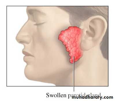 chicken pox small pox mumps