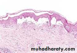 inflammation