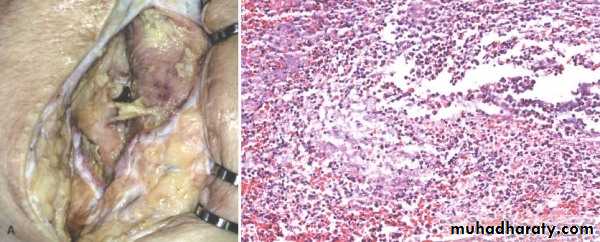 inflammation