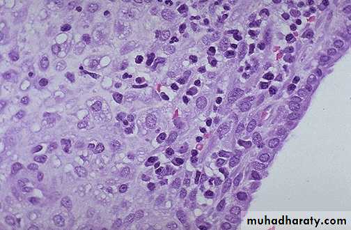 inflammation