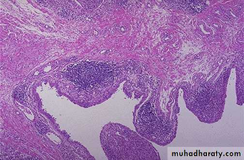 inflammation