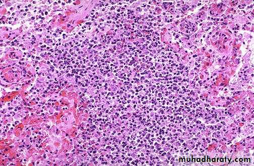 inflammation