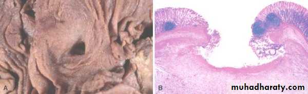inflammation