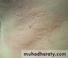 Allergic Diseases