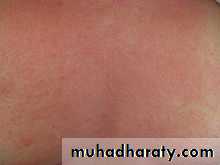 Allergic Diseases