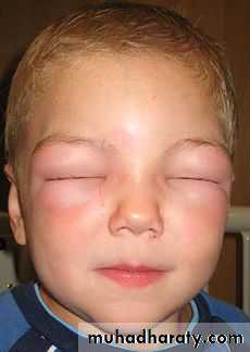 Allergic Diseases